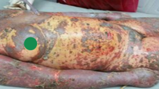 ICA: CASOS DE NECROLISIS EPIDERMICA TOXICA EN EL HOSPITAL JOSE MARIA CABRAL Y BAEZ