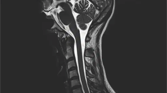 SÍNDROME MOTOR DERECHO AGUDO. MÁS ALLÁ DE UNA LESIÓN VASCULAR: A PROPÓSITO DE UN CASO
